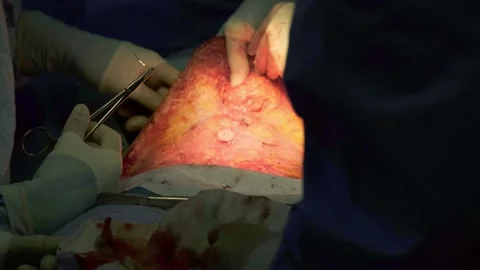 A team of doctors - surgeons performing a surgical operation Stock Footage 270470649