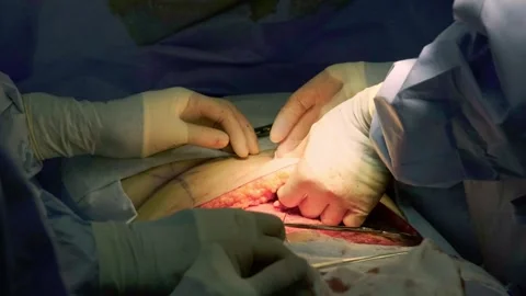 A team of doctors - surgeons performing a surgical operation Stock Footage 270471664