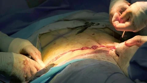 A team of doctors - surgeons performing a surgical operation Stock Footage 270473311