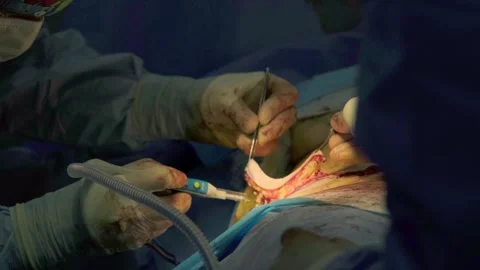 A team of doctors - surgeons performing a surgical operation Stock Footage 270473312
