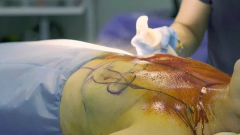 A team of doctors - surgeons performing a surgical operation Stock Footage 270482847