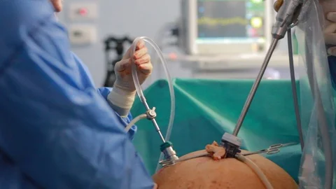 Team of doctors using laparoscopy camera surgery robot in surgical room in ho 動画素材 102223675