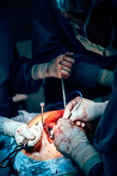 Team of Surgeons Operating. Stock Photos