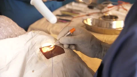 Team of surgeons in operating theater performing operation on a patient . Stockbeeldmateriaal 155705320
