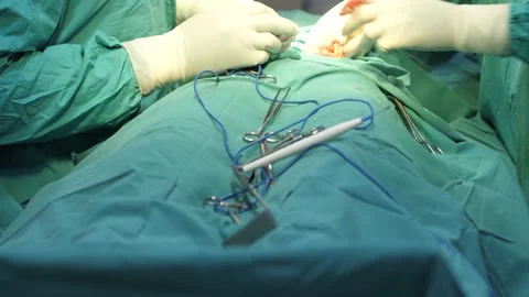 Team of surgeons in operating theater performing operation on a patient . 库存影片 156122133