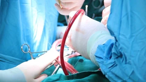 Team of surgeons performing operation on a patient Stock Footage 72405706