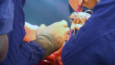 Team of surgeons performs an operation. Close-up. Stock Footage 149239347