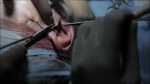Team of surgeons performs surgical operation. Close-up of doctor surgeon hands Stock Footage 221924692