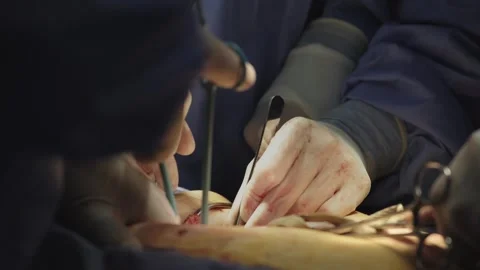 A team of surgeons at work in the operating room. Stockbeeldmateriaal 269481237