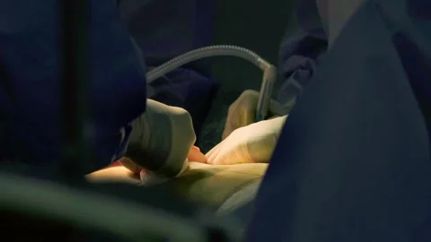 A team of surgeons at work in the operating room. Stock Footage 270468017