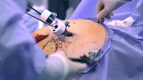 A team of surgeons at work in the operating room Stockbeeldmateriaal 270552100