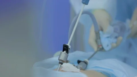 Team of surgeons works in operating room, metal manipulators remove tumors Stock Footage 128643118