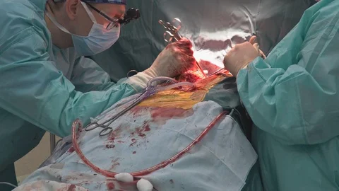 Teamwork surgeons during open heart surgery doctor holding surgical instruments Stock Footage 98524486