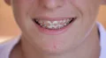 Teenager smiling and showing his dental appliance HD Footage