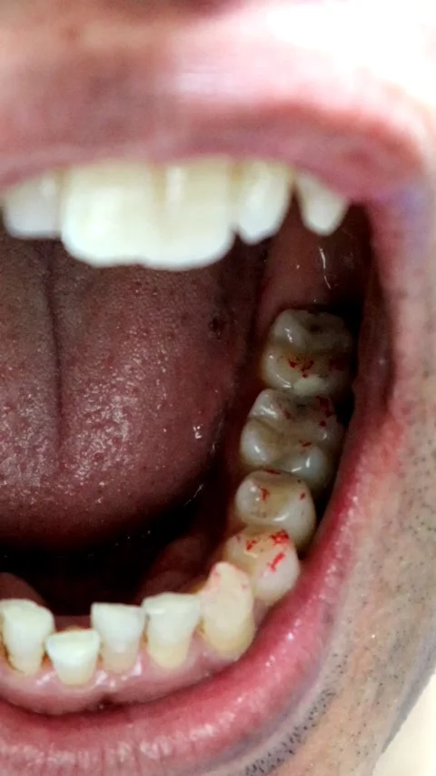 Teeth after cavity treatment Video stock 335942585