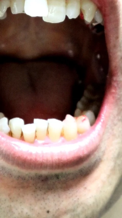 Teeth after cavity treatment Stock Footage 335949249