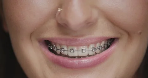 Teeth alignment by braces. Close up of female friendly smile. Dental care Vídeos de archivo 152332070