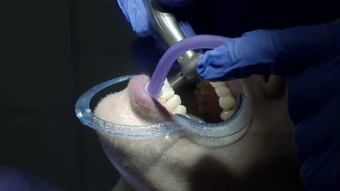 Teeth alignment in the clinic Stock Footage 149192992