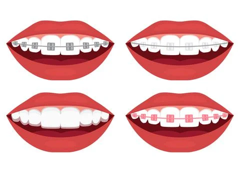 Teeth alignment. Metal, ceramic, plastic, ligature and invisible braces Stock Illustration