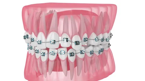 Teeth alignment by orthodontic braces isolated over white background Vídeo Stock 159695744