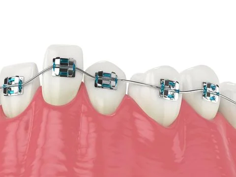 Teeth alignment by orthodontic braces isolated over white background Stock Illustration
