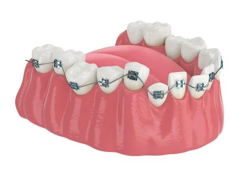 Teeth alignment by orthodontic braces isolated over white background Stock Illustration