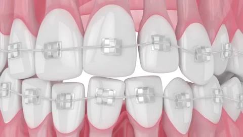 Ceramic Brackets (Clear Braces) - Align Orthodontics : Align Orthodontics