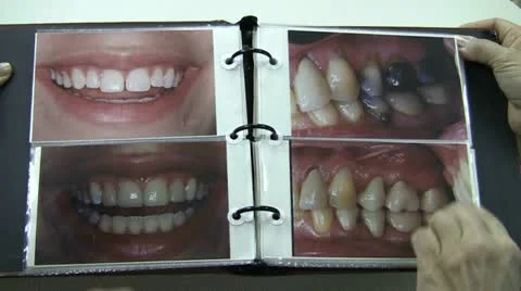 Teeth Before And After 库存影片 12635641