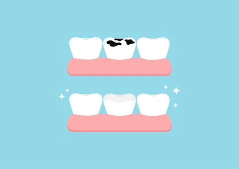 Teeth before and after multiple caries in gym dental icon set isolated. Stock Illustration