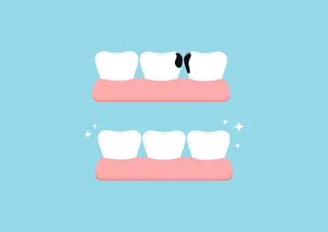 Teeth before and after proximal decay in gym dental icon set isolated on blue Stock Illustration