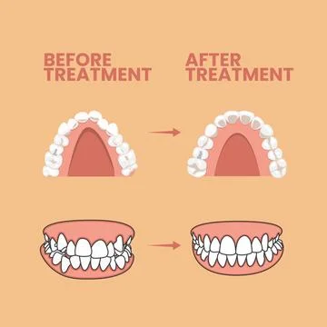 Teeth Before and After Treatment Vector Icon Illustration. Teeth Before and.. Illustrazione stock
