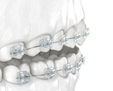 Teeth and Clear braces. Medically accurate dental 3D illustration, white styl Stock Illustration