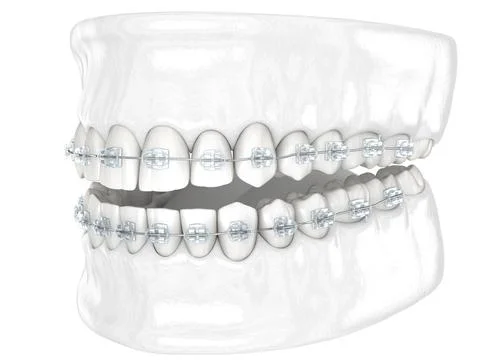 Teeth and Clear braces. Medically accurate dental 3D illustration, white styl Stock Illustration