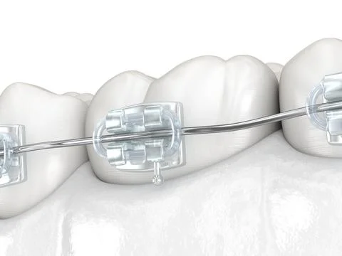 Teeth and Clear braces. Medically accurate dental 3D illustration Stock Illustration