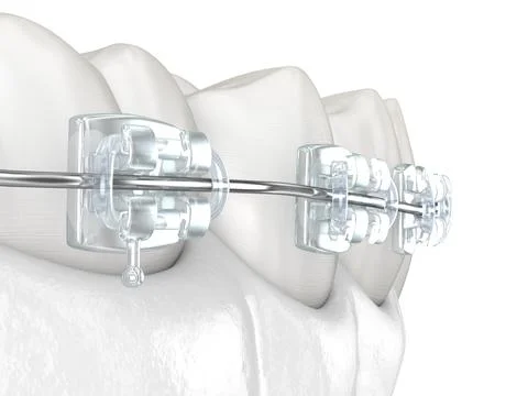 Teeth and Clear braces. Medically accurate dental 3D illustration イラスト素材