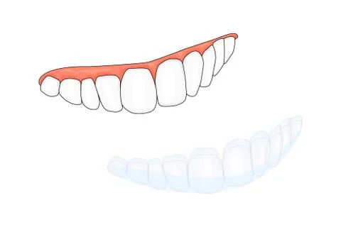 Teeth and invisalign braces or invisible retainer isolated on white background. Stock Illustration