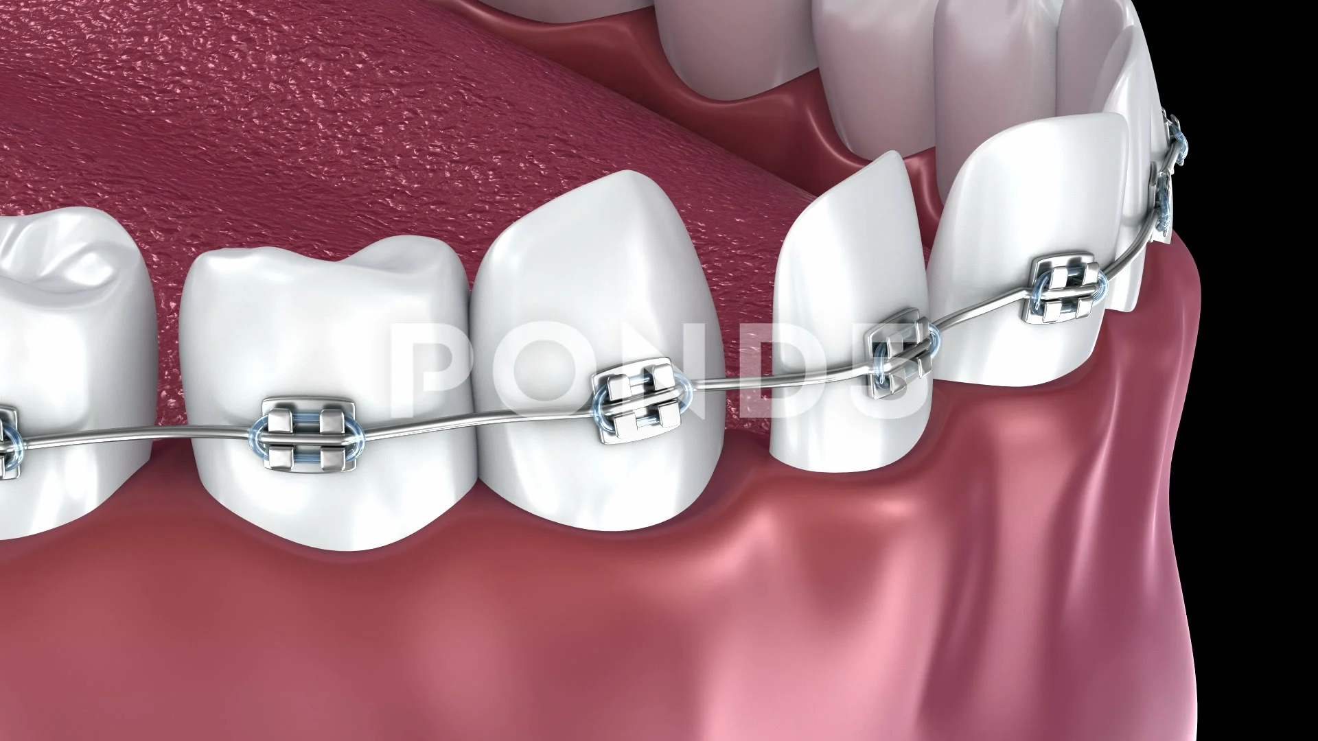 Teeth with braces Alignment process. 3D ... | Stock Video | Pond5