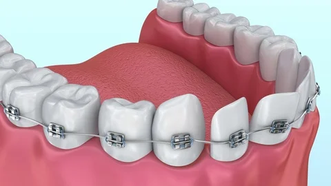 Teeth with braces Alignment process. Medically accurate 3D animation. Stock Footage