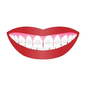 Teeth with braces and red lipstick (2) Illustrazione stock