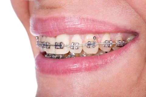 Teeth with braces, close up Stock Photos