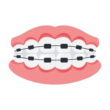 Teeth Braces Illustration on White Background. Stock Illustration