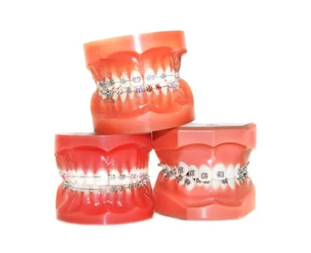 Teeth with braces isolated Stock Photos