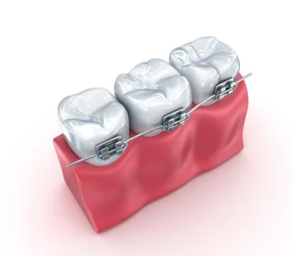 Teeth with braces isolated on white. Medically accurate 3D illustration Stock-Illustration