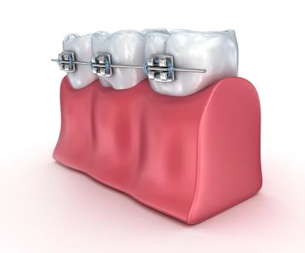 Teeth with braces isolated on white. Medically accurate 3D illustration Stock Illustration
