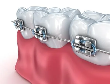 Teeth with braces isolated on white. Medically accurate 3D illustration Stock Illustration