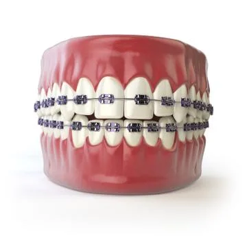 Teeth with braces or brackets isolated on white. Dental care concept. Stock Illustration
