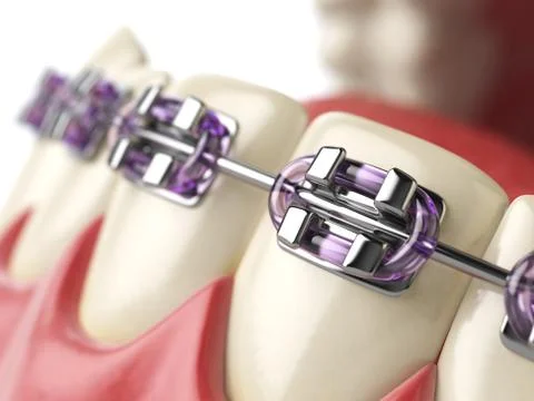 Teeth with braces or brackets in open human mouth. Dental care concept. Illustrazione stock