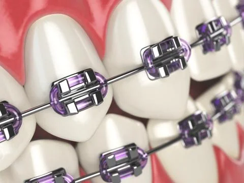 Teeth with braces or brackets in open human mouth. Dental care concept. Stock Illustration