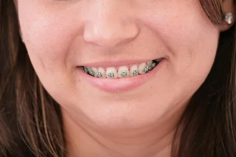 Teeth with braces Stock Photos