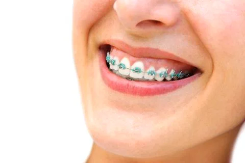 Teeth braces Stock Photos